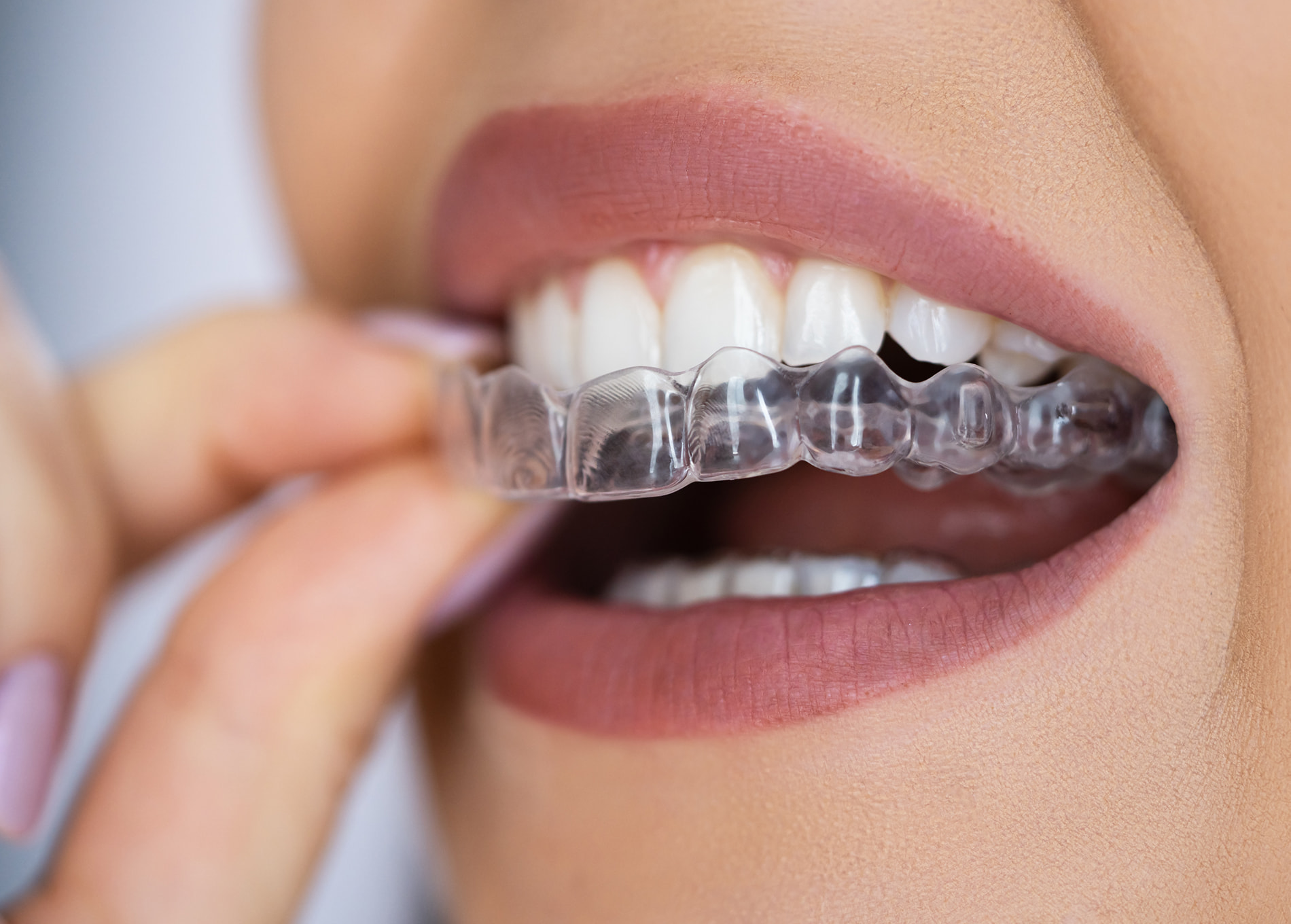Clear aligners at Clemson Dental Implant Center offer a discreet way to straighten your teeth and enhance your smile