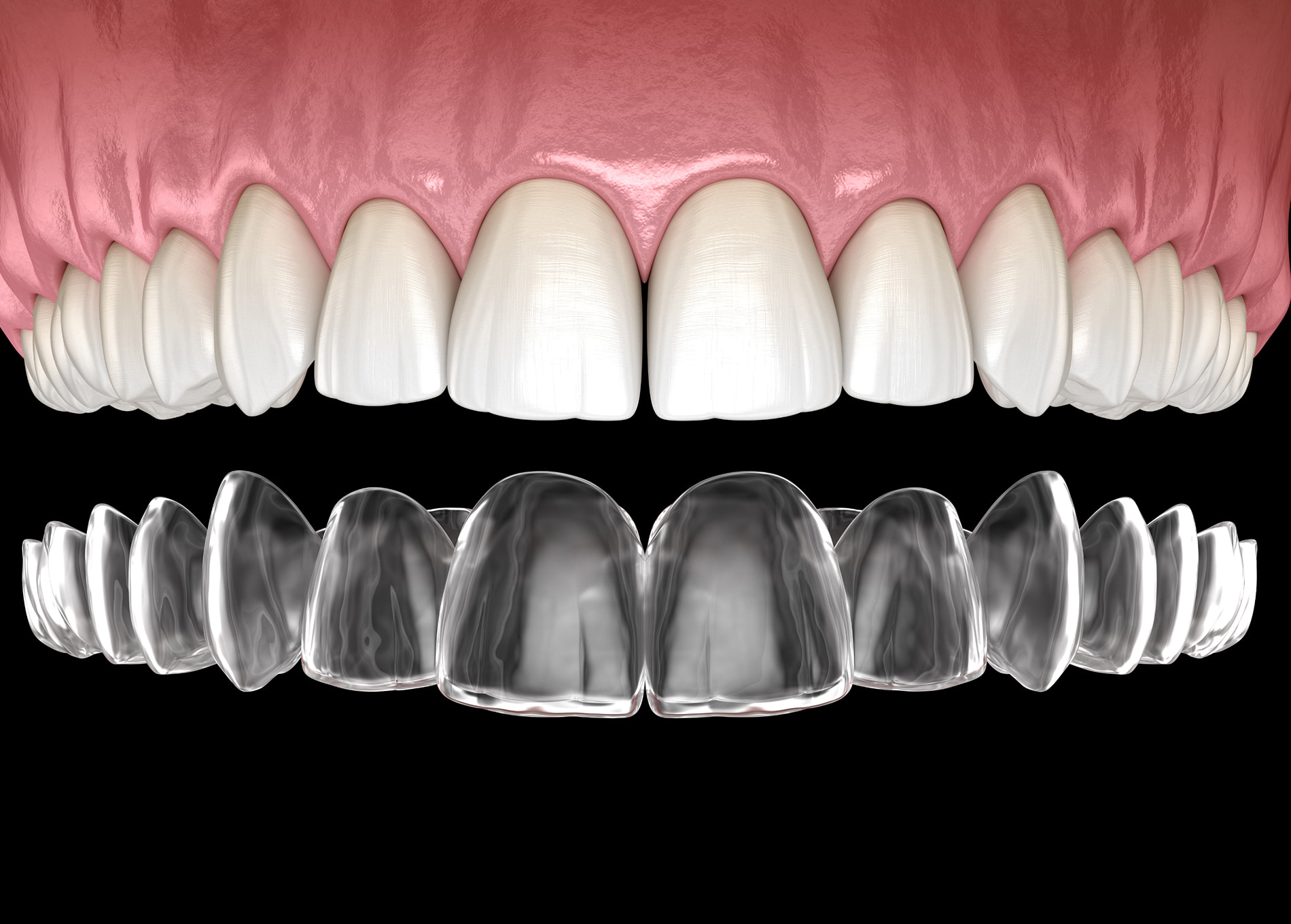 Clear aligners gently straighten teeth with virtually invisible, custom-made removable trays
