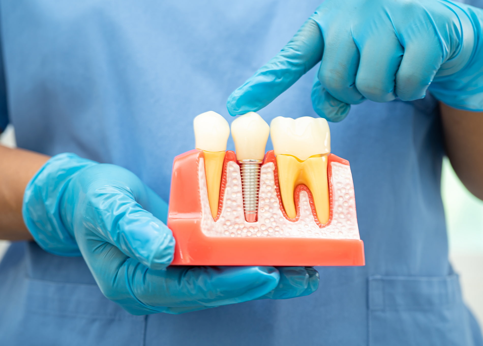 Dental implants provide a permanent solution to replace missing teeth and restore a natural, confident smile